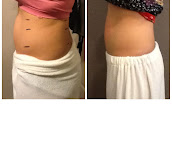 Side-by-side client abdomen photographs supplied by Results MedSpa.