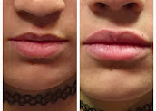 Side-by-side close-up photographs of a client’s lips.